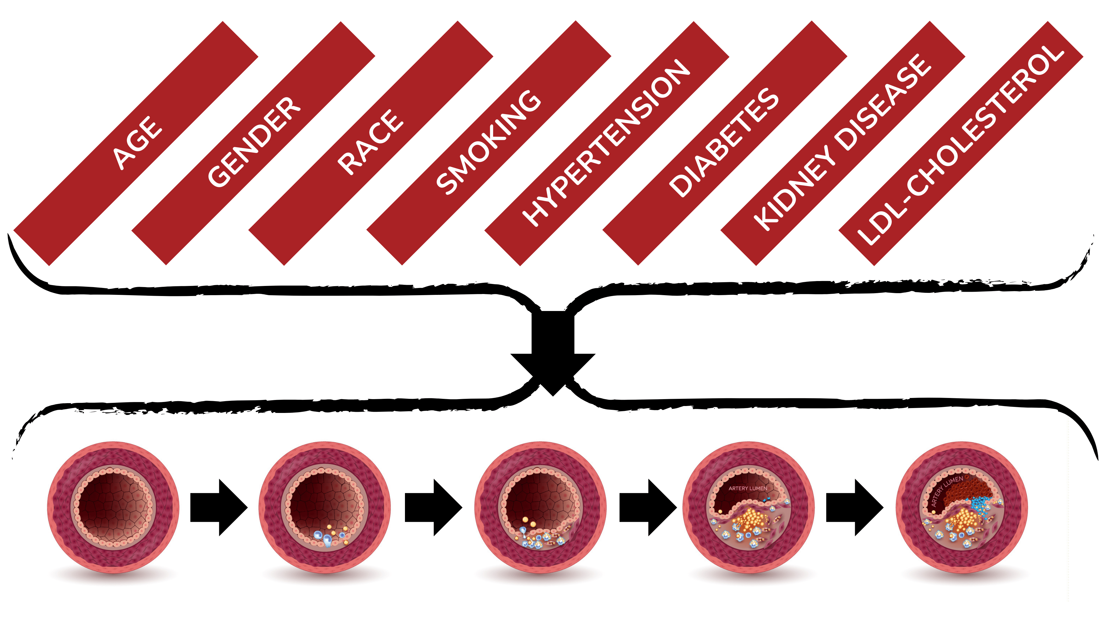 动脉粥样硬化是一种多因素疾病 动脉粥样硬化是一种多因素疾病